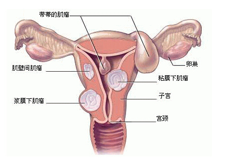 子宫肌瘤的治疗方法