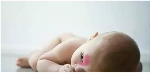 宝宝胎记是怎么形成的
